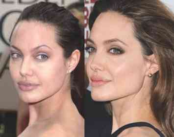 preenchimento mandibular angelina jolie