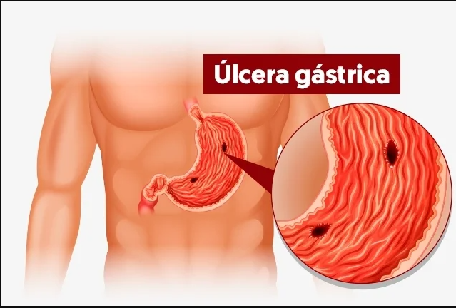 Úlcera gástrica: causas, sintomas e tratamento com misoprostol