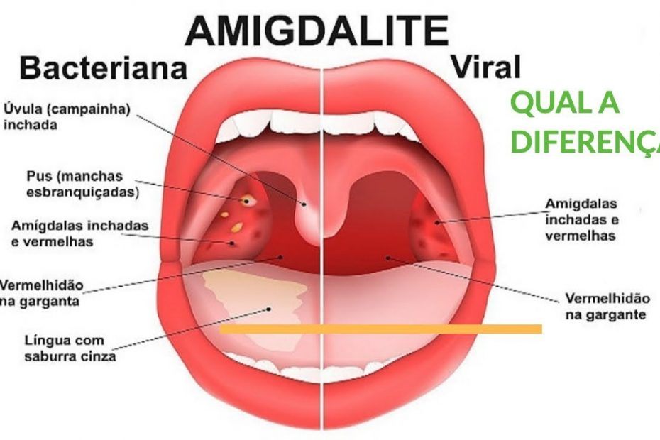 AMIGDALITE VIRAL: O QUE É E COMO TRATAR