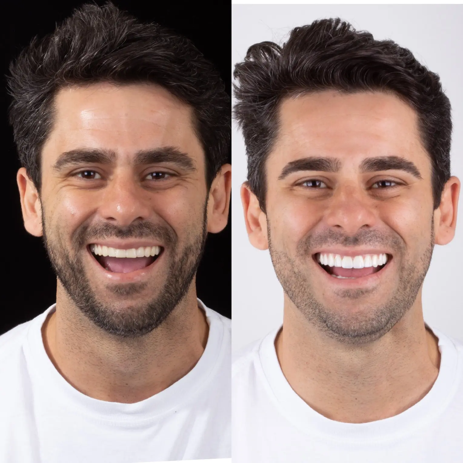 Revitalizando Sorrisos: A Ascensão das Lentes de Porcelana Dental